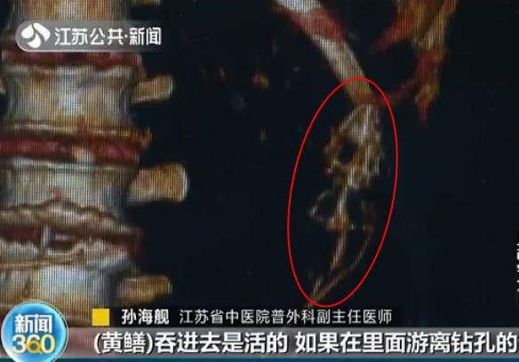 Китаец проглотил живьем двух угрей, чтобы вылечить запор, и они прогрызли ему кишечник 