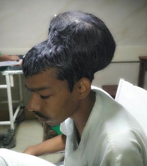 В Индии прооперировали мужчину с крупнейшей в истории опухолью головного мозга