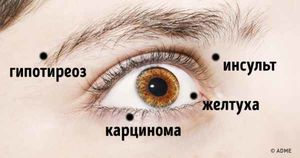 10 вещей, которые ваши глаза пытаются рассказать вам о вашем здоровье