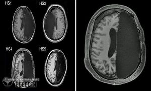 Ученые узнали как работает мышление у людей, которым в детстве удалили половину мозга