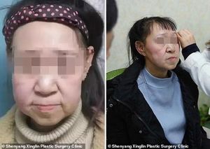 15-летней «старушке» из Китая подарили новое лицо