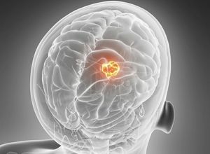 Как распознать опухоль головного мозга: основные симптомы новообразования